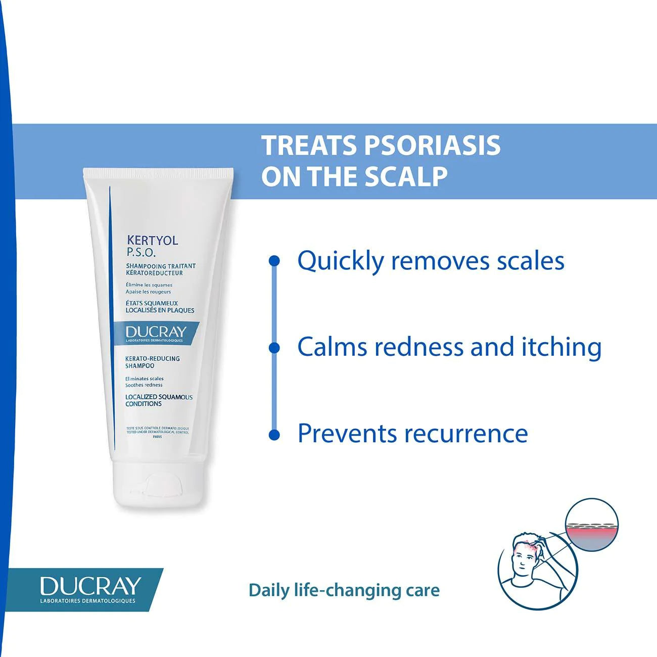 DUCRAY Kertyol P.S.O Kerato-Reducing Shampoo - Localized Squamous Conditions
